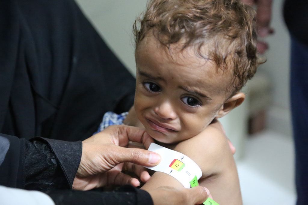 La moitié des enfants yéménites sont condamnés à un retard de croissance. D. R.