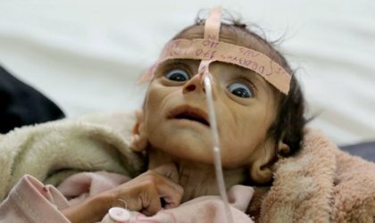 Images choquantes : les enfants yéménites souffrent de malnutrition aiguë