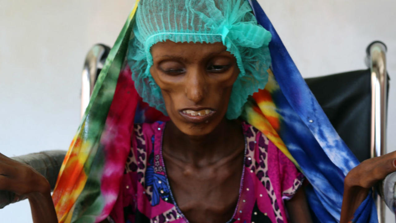 Yémen famine